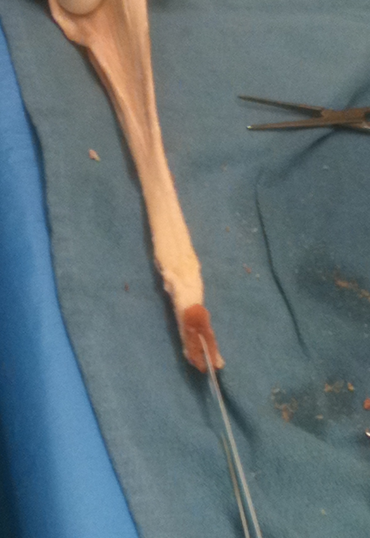 Achilles Allograft Final